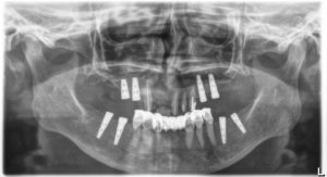 Méhes_Fogaszat_szajsebeszet_implantatum