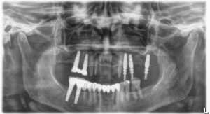 Méhes_Fogaszat_szajsebeszet_implantatum3