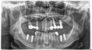 Méhes_Fogaszat_szajsebeszet_implantatum4