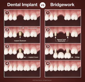 Fogászati implantátum vs. híd