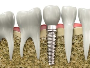 implantatum-fajtak