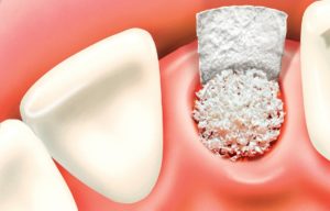 Bone-Graft