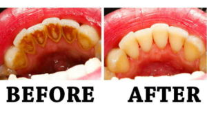 220px-Gingivitis-before-and-after-1